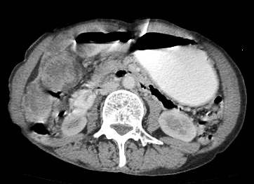 Figure 8: Advance case showing invasion of hepatic flexure of colon and also involving the antro-pyloric region medially